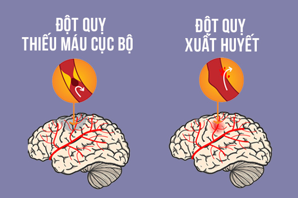 Đột quỵ não là gì? Dấu hiệu cảnh báo bị đột quỵ não