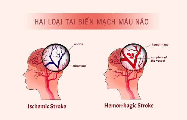 Nguyên nhân gây đột quỵ não là gì? Cách phòng ngừa đột quỵ não