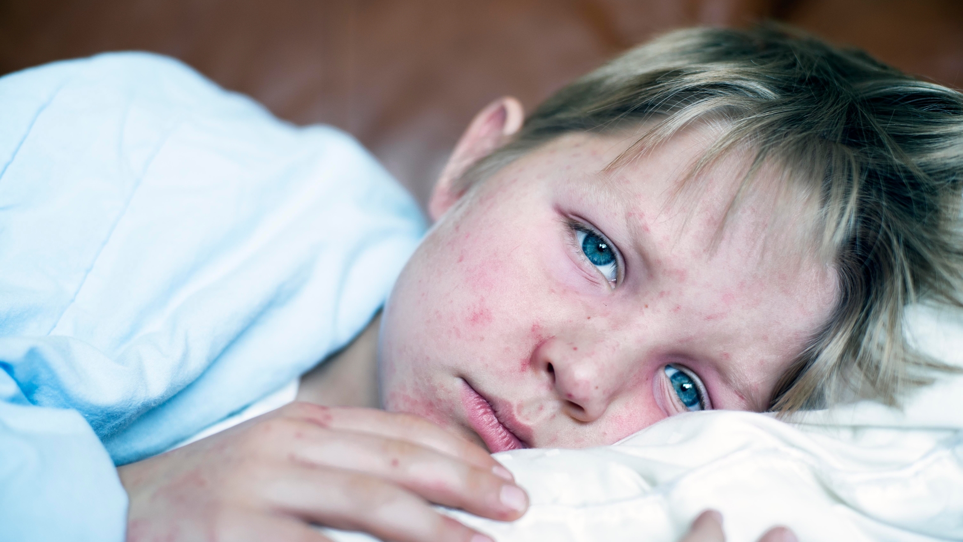Bệnh sởi ở trẻ em: nguyên nhân, biến chứng và cách phòng ngừa