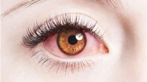 Bệnh đau mắt đỏ: nguyên nhân, phương pháp điều trị