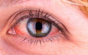 Bệnh đau mắt đỏ và những điều bạn nên biết